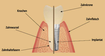zahn-mit-implantat-und-beschreibung-02